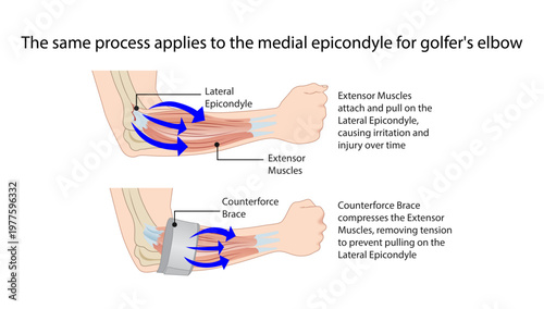 The same process applies to the medial epicondyle for golfer's elbow
Golfer’s elbow involves repetitive strain and microtears at the common flexor tendon origin on the medial epicondyle of the humerus
