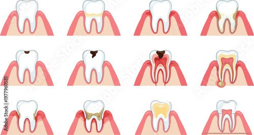 Dental tooth decay stages illustration set, caries progression gum disease and root infection with treatment concepts for oral health care education, medical concept
