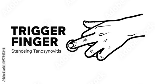 Trigger Finger Stenosing Tenosynovitis Medical Illustration with Hand Line Art