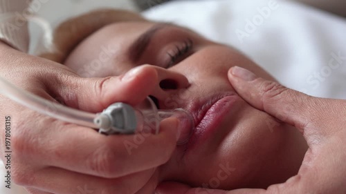 Cosmetologist Performing Vacuum Lip Plumping Procedure on Young Blonde Woman in Beauty Clinic, Non-Invasive Aesthetic Lip Enhancement Treatment Closeup