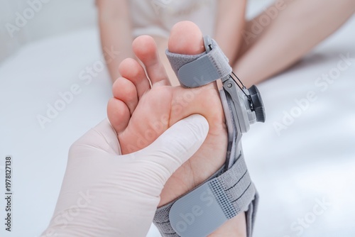 Close up view on orthopedist examines leg with hallux valgus deformity of big toe in orthopedic bandage
