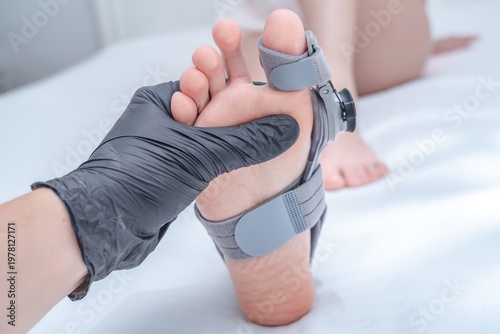 Leg with hallux valgus deformity of big toe in orthopedic bandage in orthopedist