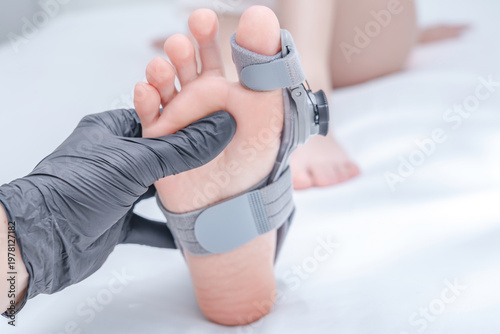 Leg with hallux valgus deformity of big toe in orthopedic bandage in orthopedist