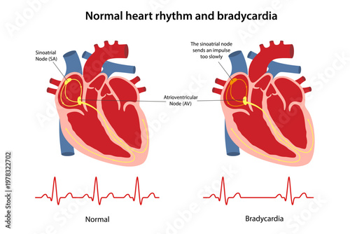 Comparison of normal and bradycardiac human heart rhythms. Cardiogram. Flat style vector illustration isolated on a white background.