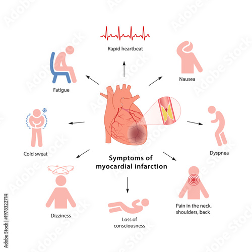 Myocardial infarction. Symptoms of myocardial infarction. Flat style medical icons isolated on a white background.