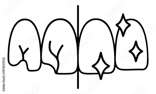 Tooth restoration before and after repair of cracks and chips, aesthetic dental treatment with smooth enamel result