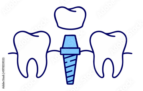 Dental Implant Procedure with Artificial Tooth Root and Crown Replacement, Missing Tooth Restoration