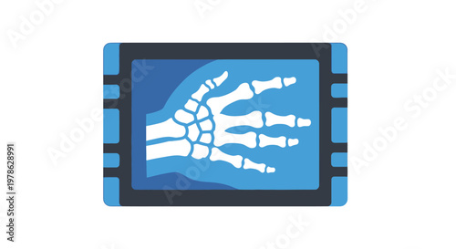 A medical X-ray image of a human hand with bones visible