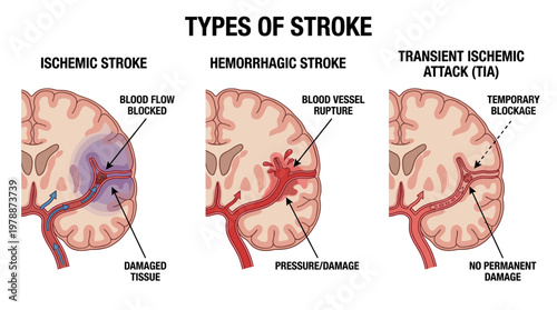 Medical illustration of the three types of stroke: ischemic, hemorrhagic, and transient ischemic attack (TIA) in the human brain. Concept of cerebrovascular health and emergency medicine