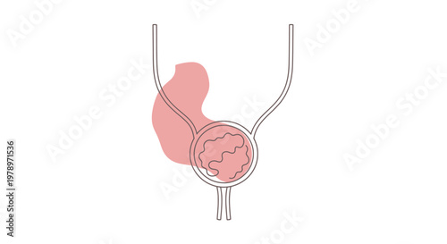 Simplified medical illustration of the male reproductive system and urinary tract, depicting the prostate gland with an internal inflamed or enlarged area highlighted in pink