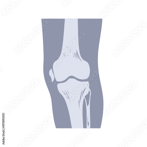 A simplified medical illustration showing the human knee joint structure