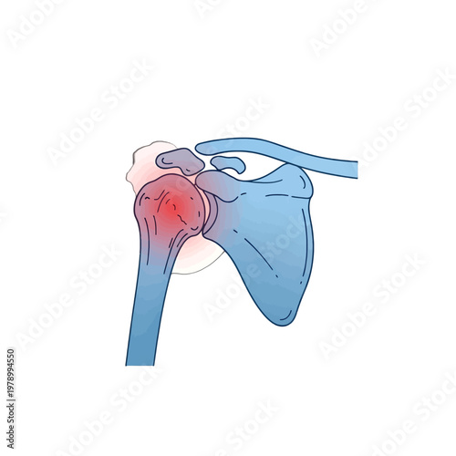 A medical illustration showing inflammation in the human shoulder joint area