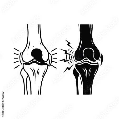 Comparison of healthy and arthritic knee joints in medical illustration