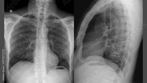 Chest X‑ray, PA and Lateral Views