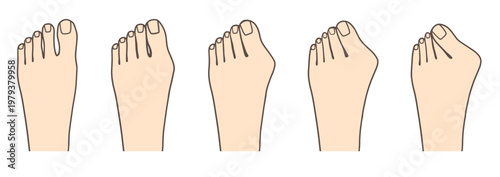 外反母趾の進行具合を比較した症状別イラスト