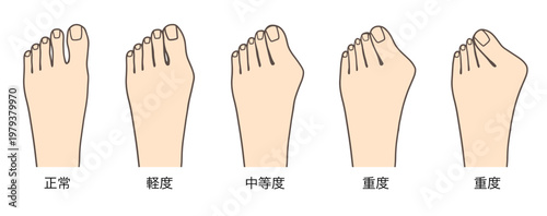 外反母趾の進行具合を比較した症状別イラスト（軽症・中等度・重症）