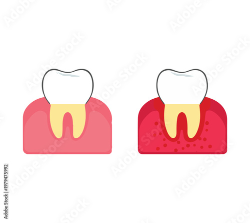 Healthy and unhealthy gum and tooth comparison illustration for dental health education purposes