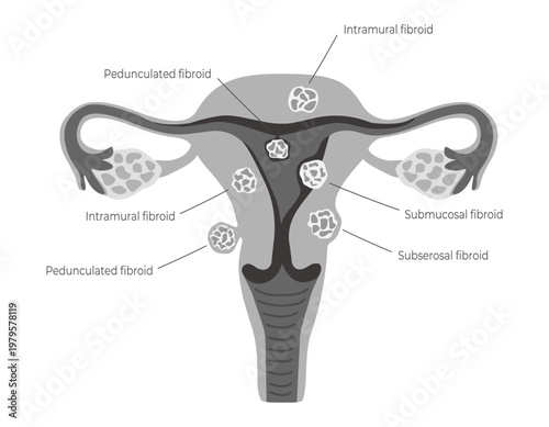 Female uterus with common types of uterine fibroids. Educational medical diagram for use in gynecology and the reproductive system. Vector illustration isolated on white background.