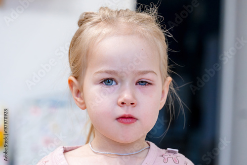 Little girl with swollen red eye, conjunctivitis