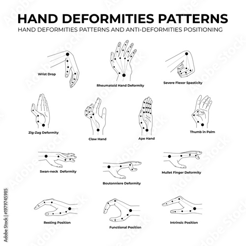 hand deformity pattern and anti-deformity positioning flat illustration