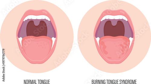 Comparison medical diagram between normal tongue and burning mouth syndrome showing inflammation and redness symptoms