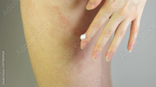 Applying cream on skin with redness, irritation, or allergic reaction on a human leg, medical dermatology concept. Eczema on the leg of a pregnant woman.