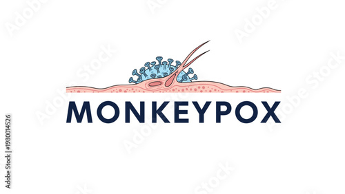 Medical illustration showing the monkeypox virus on the surface of human skin with the word monkeypox in bold dark blue letters.