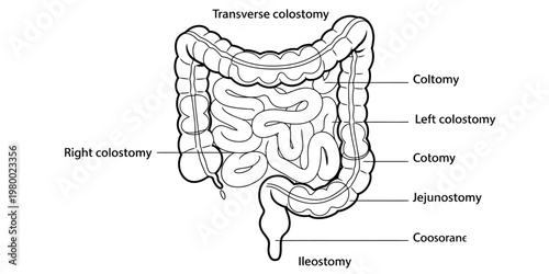 A medical illustration showing the anatomical locations for various types of abdominal stoma sites Vector, illustration