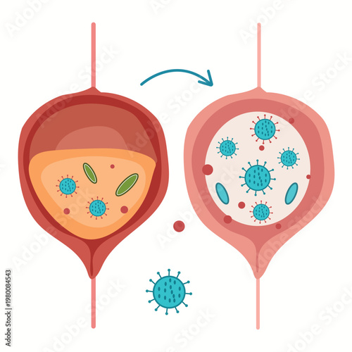 Urinary bladder infection stages showing bacteria spread in healthy and diseased organ vector