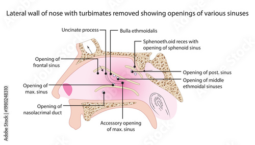 Lateral wall of nose with turbimates removed showing openings of various sinuses
Lateral nasal wall with turbinates removed showing sinus openings into meatuses including maxillary, frontal, ethmoidal