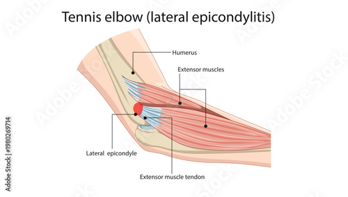 Tennis Elbow (Lateral Epicondylitis)
Diagram showing inflammation of the extensor tendon at the lateral epicondyle of the humerus.