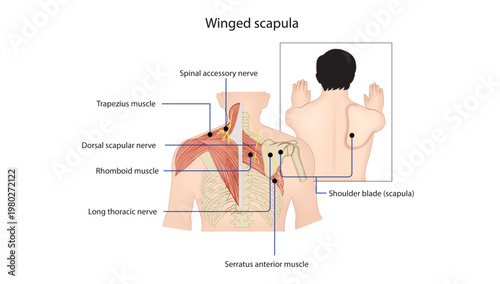 Winged Scapula and Nerve Injuries
Diagram showing winged scapula due to long thoracic nerve injury affecting serratus anterior muscle.