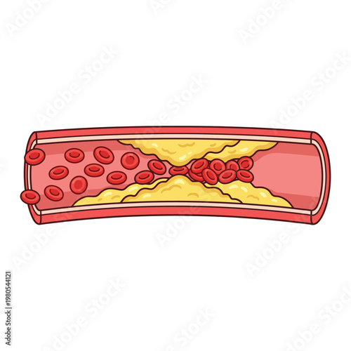 cholesterol-clogged blood vessel vector illustration element .