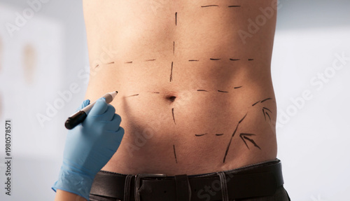 Cuadro en lienzo Plastic Surgeon Gently Marks Male Patient’s Abdomen In Preparation