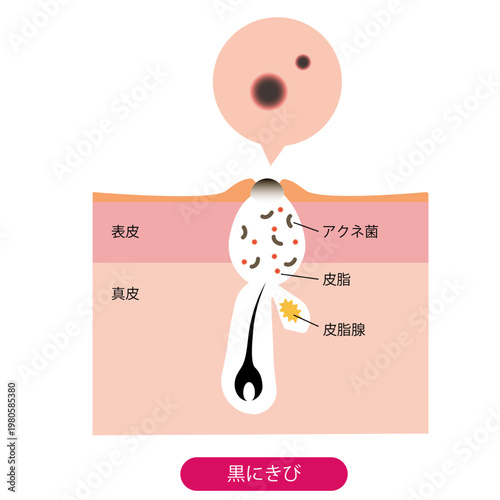 黒ニキビ