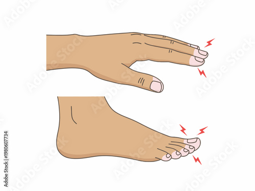 Peripheral neuropathy and numbness in hand and foot illustration