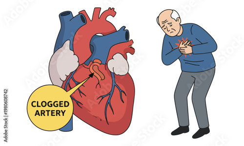 Heart attack illustration with clogged artery diagram and senior man