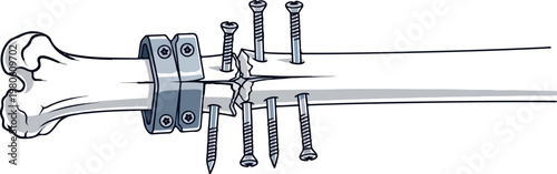 A fractured bone repaired with surgical screws and a plate