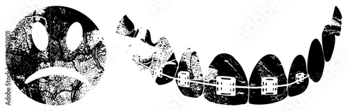 Sad with textured halftone, dental braces on upper teeth, cartoonish dental appliance, isolated vector graphic, black and white illustration.