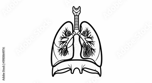 Anatomical illustration of lungs with darkened areas representing nodules or tumors