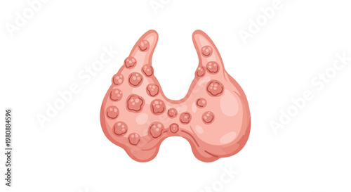 Illustration of a human thyroid gland with nodules, representing a medical condition or health issue