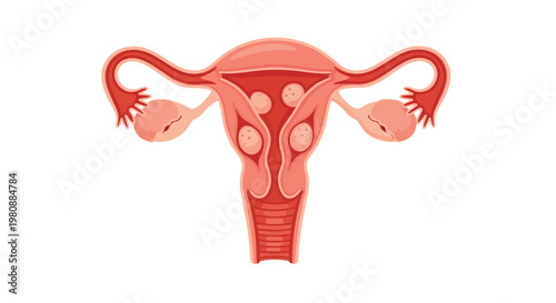 Illustration of the female reproductive system showing uterus, fallopian tubes, and ovaries with fibroids