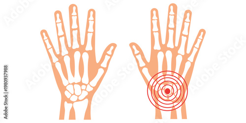 Hand Pain Illustration: An anatomical illustration showcases the human hand with highlighted pain signals, offering a visual representation of discomfort and injury.