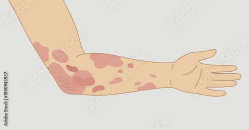 Arm with eczema showing dry and irritated skin, flat natural colors, isolated on removable background