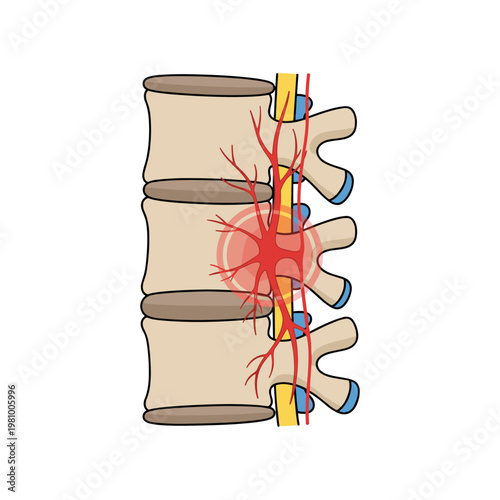 Human spine with highlighted nerve root and red marker