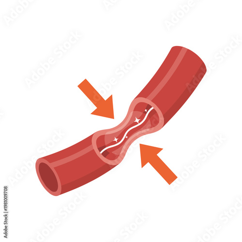 Red vessel with narrowed section and blockage indicated by orange arrows