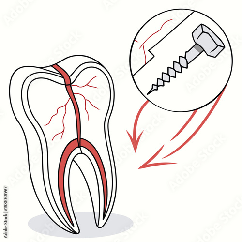 Tooth root canal treatment and dental screw illustration with pain relief