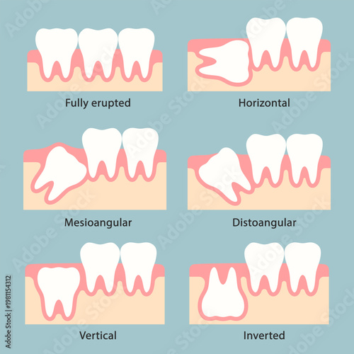Medical illustration of wisdom tooth eruption stages and various impaction angles in human jaw
