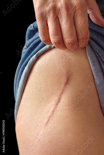 Minimally invasive Total hip replacement, 4.5 years later.