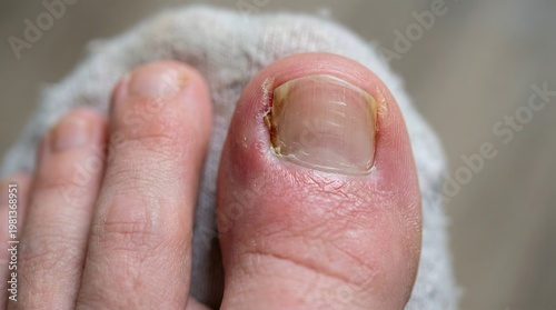Painful Inflamed Ingrown Toenail with Redness and Swelling on Foot